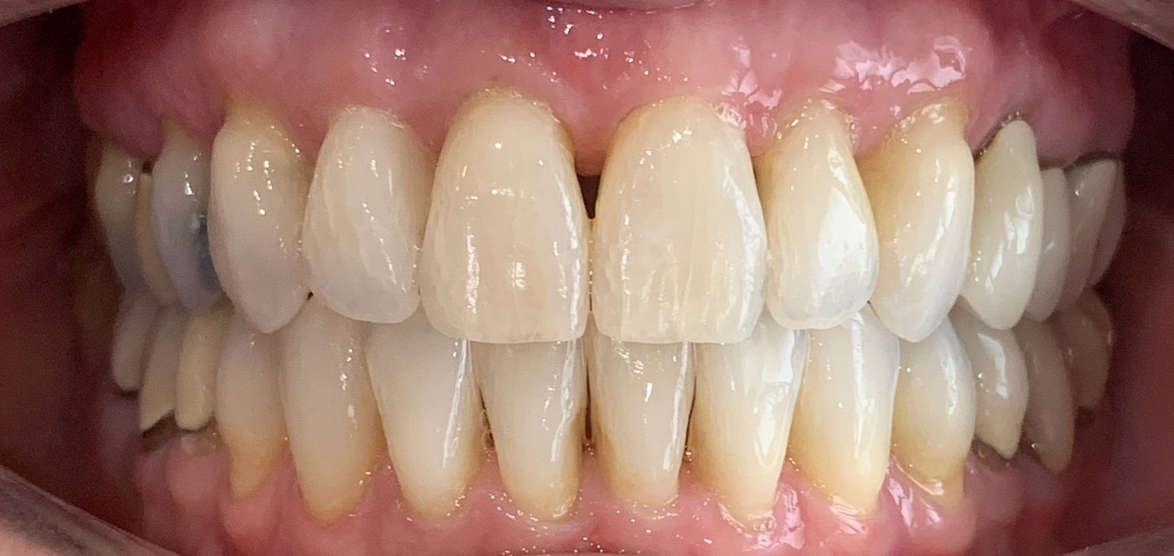 case 2 after