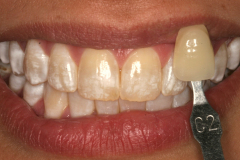 Stained teeth with a shade guide