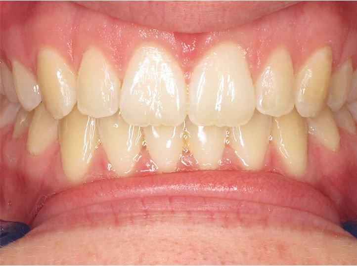case 1 after