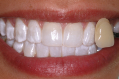 Whitened teeth with a shade guide