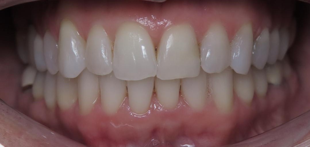 case 4 after