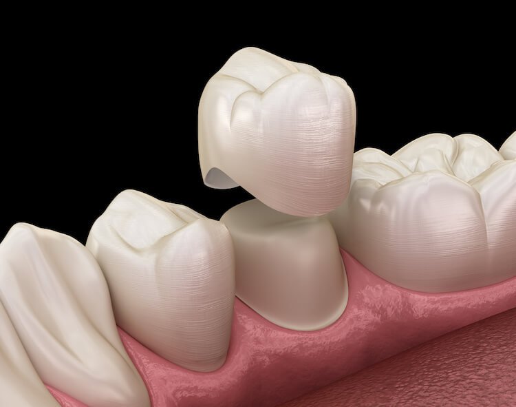 dental crowns in Red Bank